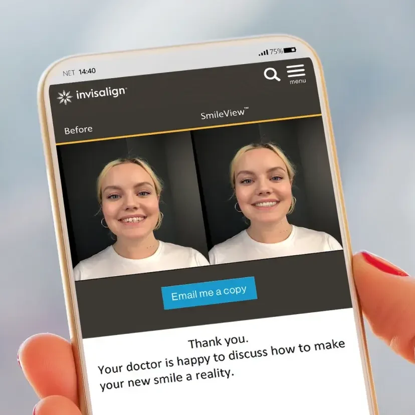 Invisalign SmileView Simulation auf dem Smartphone