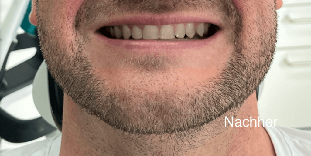 Lächeln-Simulation mit Invisalign – nachher