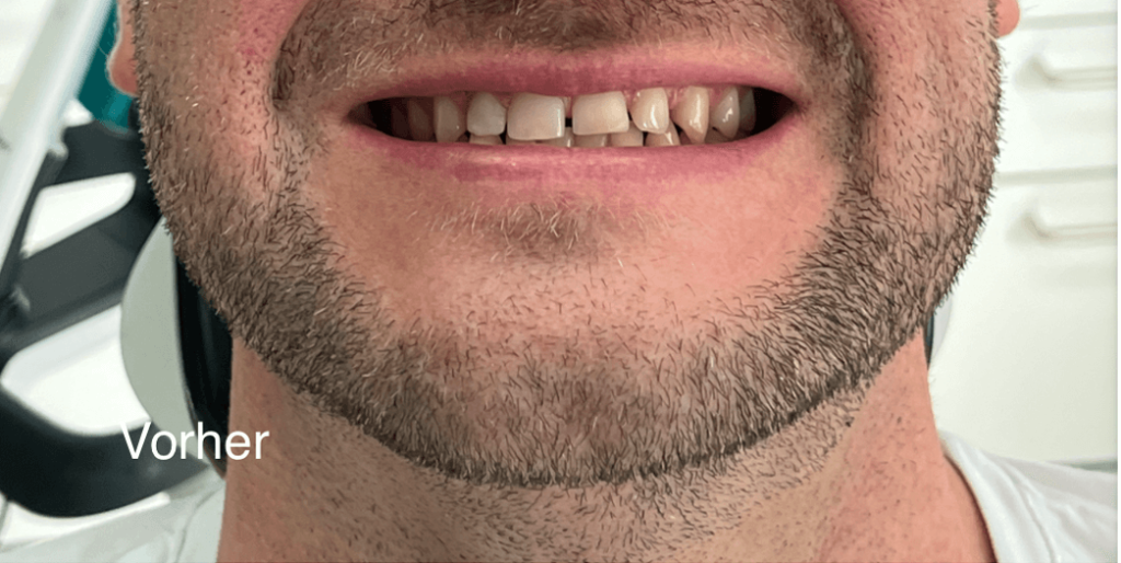 Lächeln-Simulation mit Invisalign – vorher
